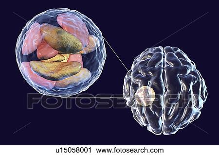 Stock Image - Brain abscess caused by Toxoplasma gondii, illustration. Fotosearch