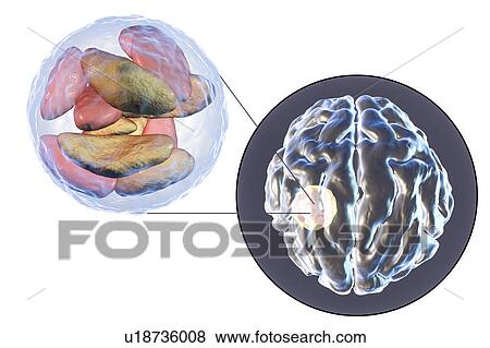 Stock Photo - Brain abscess caused by Toxoplasma gondii, illustration. Fotosearch
