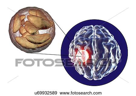 Stock Photo - Brain abscess caused by Toxoplasma gondii, illustration. Fotosearch