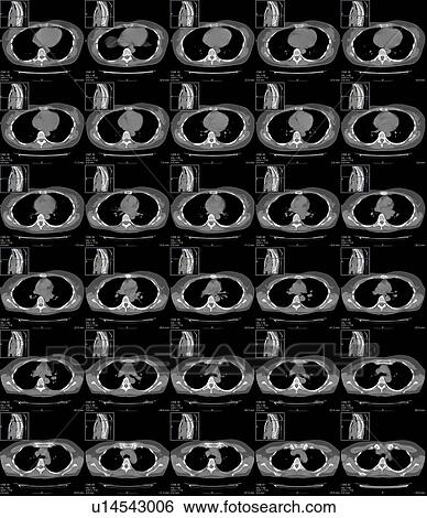 Stock Photograph - Chest anatomy, CT scans. Fotosearch