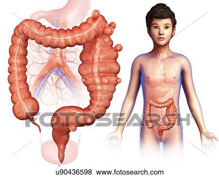 Stock Photo - Child with diverticulosis, illustration. Fotosearch