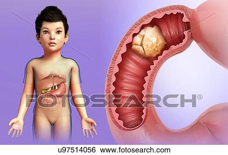 Child with intestinal cancer, illustration View Large Photo Image Stock Photograph - Child with intestinal cancer, illustration. Fotosearch