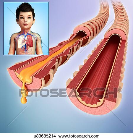 Child's infected and normal bronchi, illustration View Large Photo Image Picture - Child's infected and normal bronchi, illustration. Fotosearch