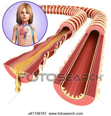 Child's infected and normal bronchi, illustration View Large Photo Image Stock Image - Child's infected and normal bronchi, illustration. Fotosearch