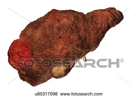 Stock Photo - Cirrhotic liver with hepatocellular carcinoma, illustration. Fotosearch