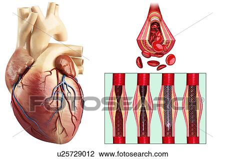 Stock Image - Coronary angioplasty stent insertion, illustration. Fotosearch