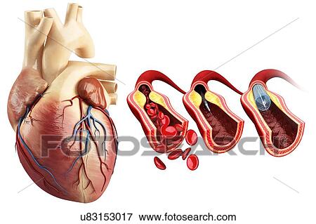 Coronary angioplasty stent insertion, illustration View Large Photo Image Stock Photo - Coronary angioplasty stent insertion, illustration. Fotosearch