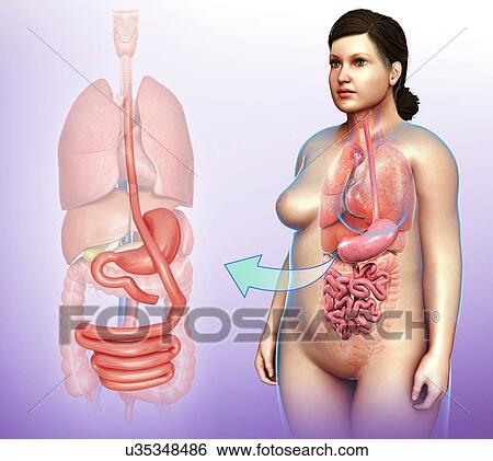 Stock Photograph - Gastric bypass, illustration. Fotosearch