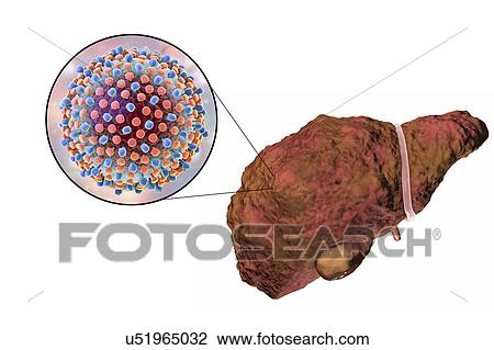 Stock Image - Liver cirrhosis due to Hepatitis C, illustration. Fotosearch