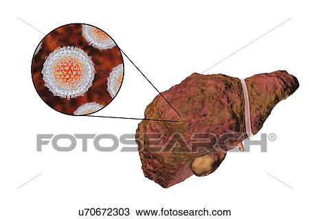 Liver cirrhosis due to Hepatitis C, illustration View Large Photo Image Stock Image - Liver cirrhosis due to Hepatitis C, illustration. Fotosearch