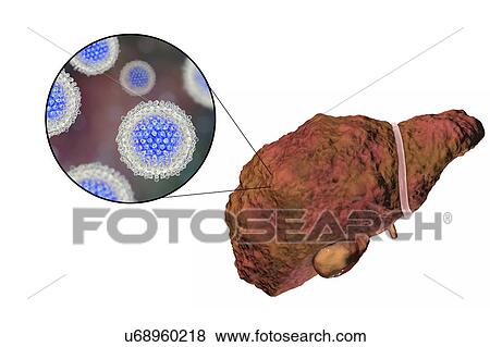Stock Photo - Liver cirrhosis due to Hepatitis C, illustration. Fotosearch