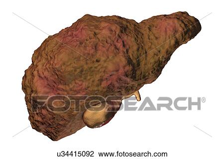 Stock Image - Liver cirrhosis, illustration. Fotosearch