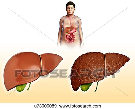 Stock Photo - Liver cirrhosis, illustration. Fotosearch