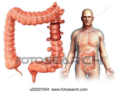 Picture - Man with diverticulosis, illustration. Fotosearch