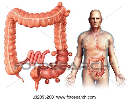 Man with diverticulosis, illustration View Large Photo Image Stock Image - Man with diverticulosis, illustration. Fotosearch
