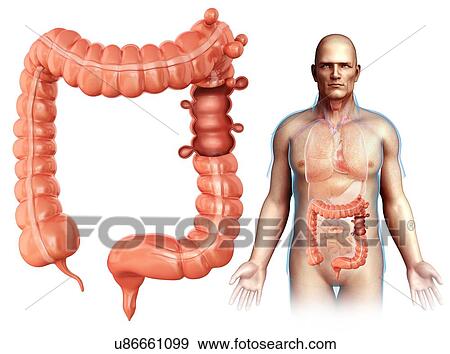 Stock Photo - Man with diverticulosis, illustration. Fotosearch