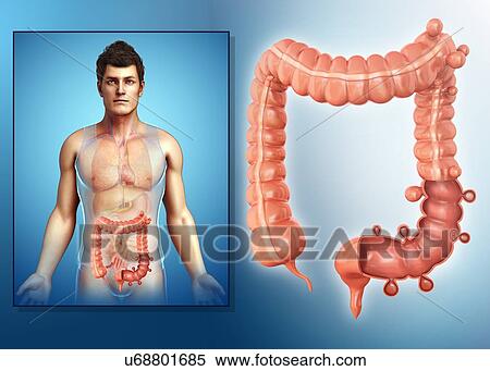 Man with diverticulosis, illustration View Large Photo Image Stock Photography - Man with diverticulosis, illustration. Fotosearch