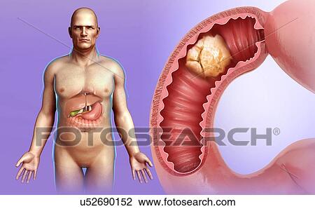 Man with intestinal cancer, illustration View Large Photo Image Stock Image - Man with intestinal cancer, illustration. Fotosearch