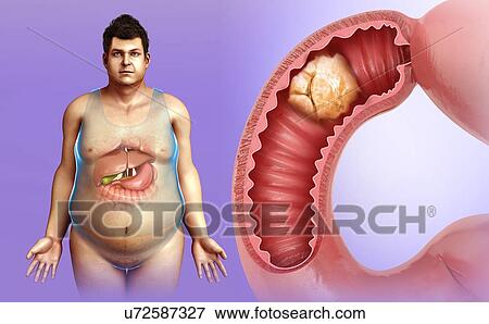 Stock Photo - Man with intestinal cancer, illustration. Fotosearch