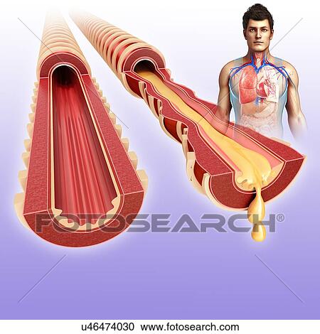 Stock Image - Normal and infected bronchi, illustration. Fotosearch