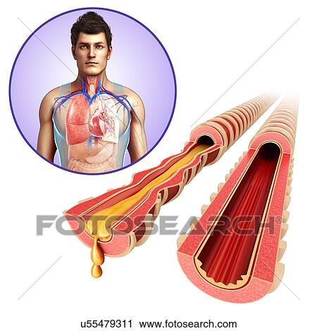 Normal and infected bronchi, illustration View Large Photo Image Stock Image - Normal and infected bronchi, illustration. Fotosearch