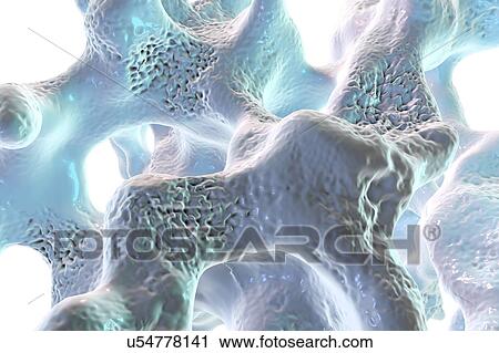 Stock Image - Osteoporosis, illustration. Fotosearch