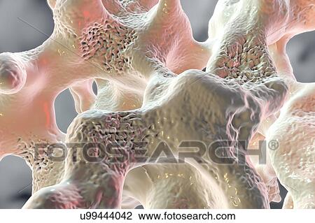 Stock Image - Osteoporosis, illustration. Fotosearch