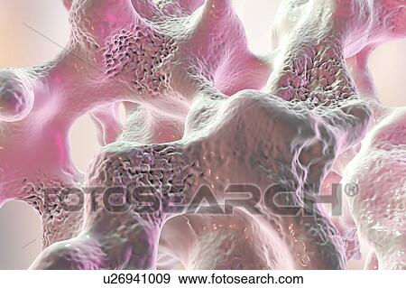 Stock Photo - Osteoporosis, illustration. Fotosearch