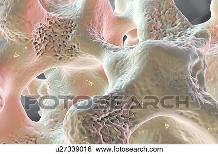 Stock Photograph - Osteoporosis, illustration. Fotosearch