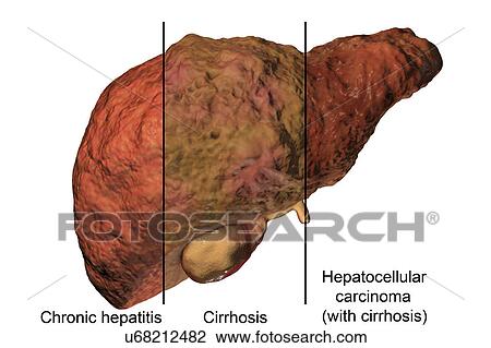 Stock Image - Stages of liver disease, illustration. Fotosearch