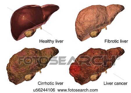 Stock Photograph - Stages of liver disease, illustration. Fotosearch