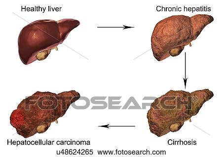 Stages of liver disease, illustration View Large Photo Image Stock Photography - Stages of liver disease, illustration. Fotosearch