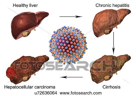 Stages of liver disease in hepatitis C, illustration View Large Photo Image Picture - Stages of liver disease in hepatitis C, illustration. Fotosearch