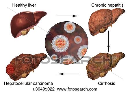 Stages of liver disease in hepatitis C, illustration View Large Photo Image Stock Image - Stages of liver disease in hepatitis C, illustration. Fotosearch