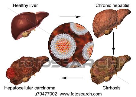 Stages of liver disease in hepatitis C, illustration View Large Photo Image Stock Image - Stages of liver disease in hepatitis C, illustration. Fotosearch