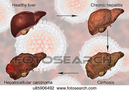 Stock Image - Stages of liver disease in hepatitis C, illustration. Fotosearch