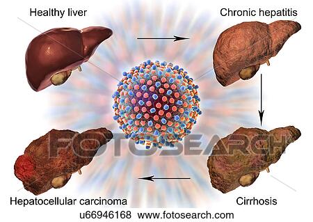 Stock Photo - Stages of liver disease in hepatitis C, illustration. Fotosearch