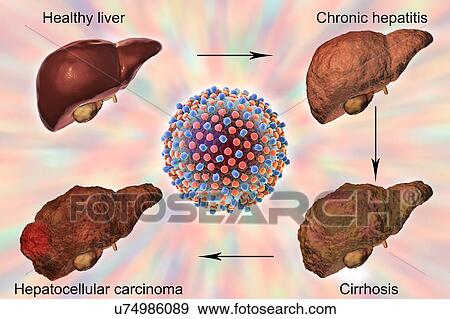 Stages of liver disease in hepatitis C, illustration View Large Photo Image Stock Photo - Stages of liver disease in hepatitis C, illustration. Fotosearch