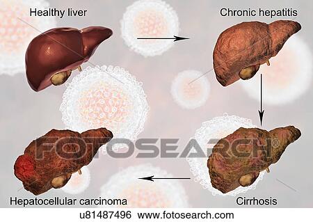 Stages of liver disease in hepatitis C, illustration View Large Photo Image Stock Photograph - Stages of liver disease in hepatitis C, illustration. Fotosearch