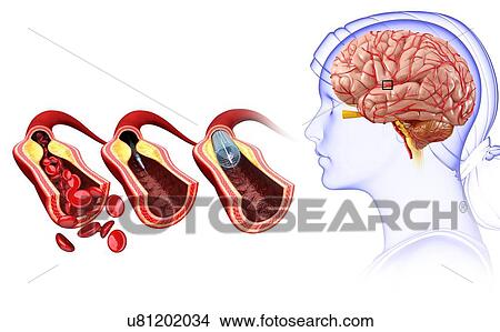 Picture - Stroke treatment, illustration. Fotosearch