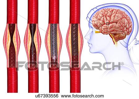 Stroke treatment, illustration View Large Photo Image Stock Photograph - Stroke treatment, illustration. Fotosearch