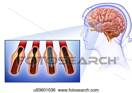 Stock Photograph - Stroke treatment, illustration. Fotosearch