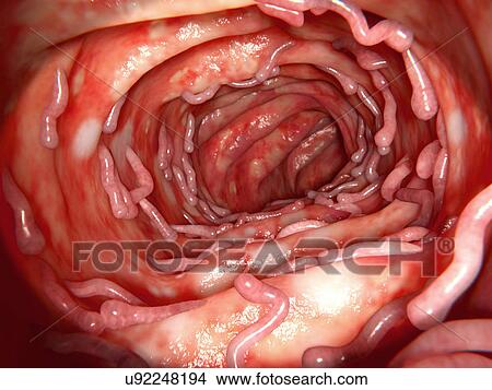 Ulcerative colitis and pseudopolyps, illustration View Large Photo Image Picture - Ulcerative colitis and pseudopolyps, illustration. Fotosearch