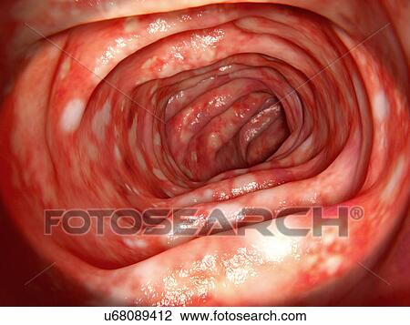 Ulcerative colitis, illustration View Large Photo Image Stock Image - Ulcerative colitis, illustration. Fotosearch