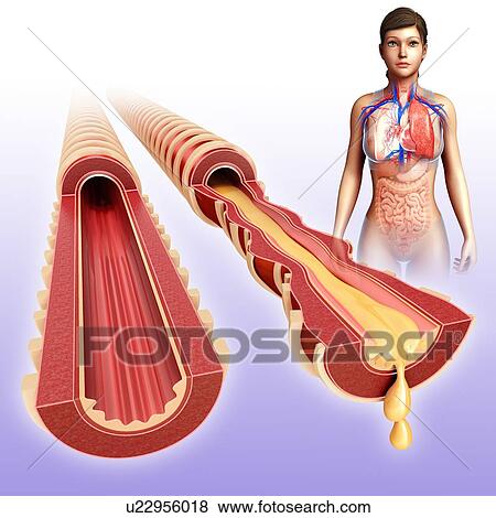 Woman's normal and infected bronchi, illustration View Large Photo Image Stock Photo - Woman's normal and infected bronchi, illustration. Fotosearch