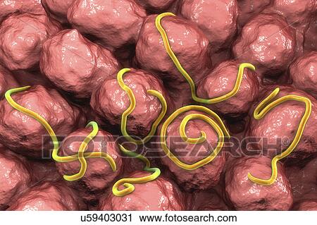 Stock Image - Threadworms in the gut, illustration. Fotosearch