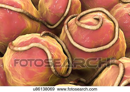 Stock Photo - Threadworms in the gut, illustration. Fotosearch
