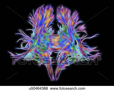 Stock Photo - White matter fibres of the human brain, DSI scan. Fotosearch
