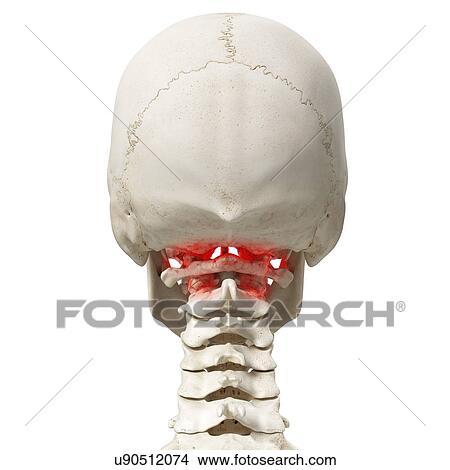 Picture - Arthritis in the atlas vertebrae, illustration.. Fotosearch