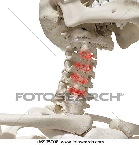 Arthritis in the cervical spine, illustration. View Large Photo Image Stock Photograph - Arthritis in the cervical spine, illustration.. Fotosearch